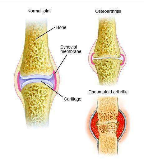 Arthritis1.jpg